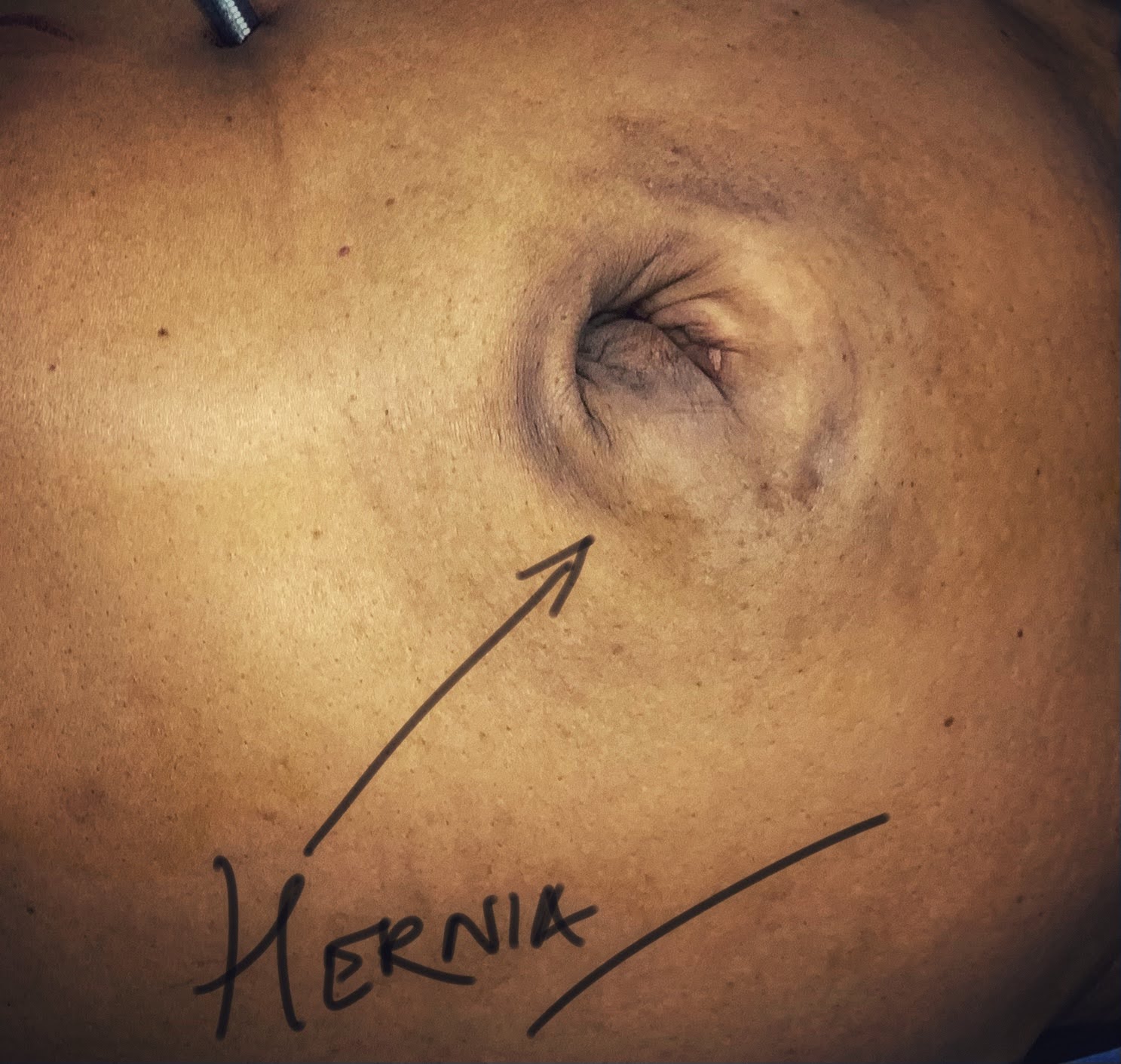 Large ventral and recurrent incisional hernia with robotic repair process